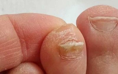Der Trick zur Reduzierung der Zehennageldicke: Omas Hausmittel neu entdeckt
