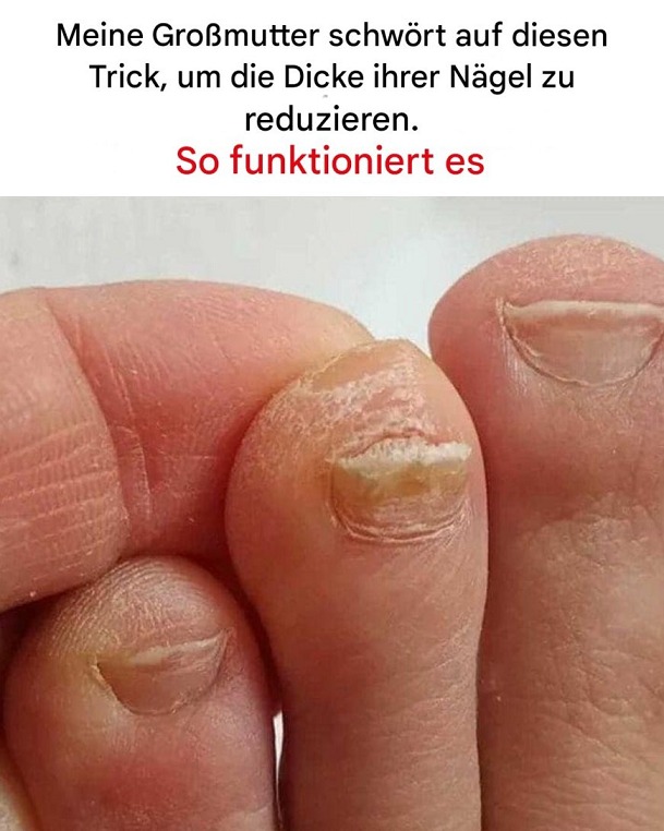 Der Trick zur Reduzierung der Zehennageldicke: Omas Hausmittel neu entdeckt