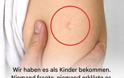 Die Wahrheit hinter der mysteriösen runden Narbe am Oberarm