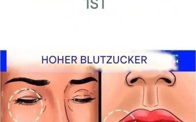 12 Anzeichen dafür, dass Ihr Blutzucker zu hoch ist
