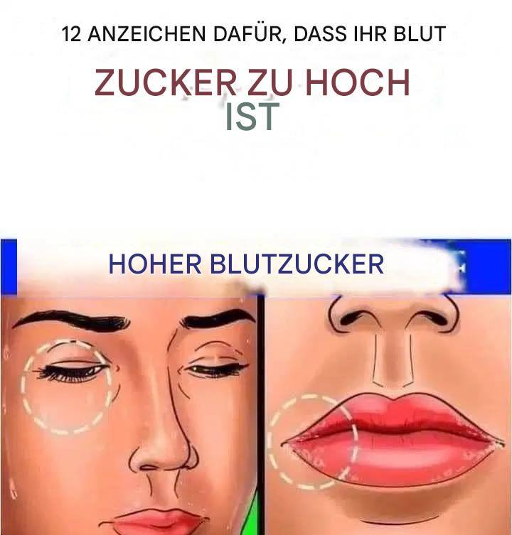 12 Anzeichen dafür, dass Ihr Blutzucker zu hoch ist