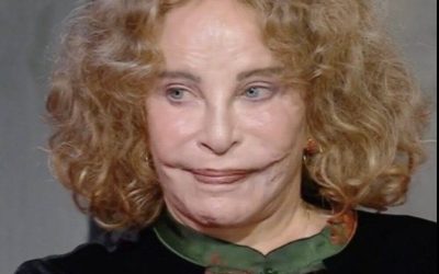 Sie wird von anderen als die schönste Frau der Welt angesehen – ihr Gesicht ist teilweise. 👧💫Es war ein tragischer Unfall, der sich völlig verändert hat. 💔🤷‍♂️Aujourd’hui, diese Fans waren überrascht, als sie sahen, wie es schien, als hätten sie sich verändert, und seltener war es, als würde die Aufklärung in der Straße stattfinden. 😮🔍Wissen Sie, wer das ist? ➡️Entdecken Sie meinen Namen und schauen Sie sich die Fotos und Kommentare an!📸⬇️⬇