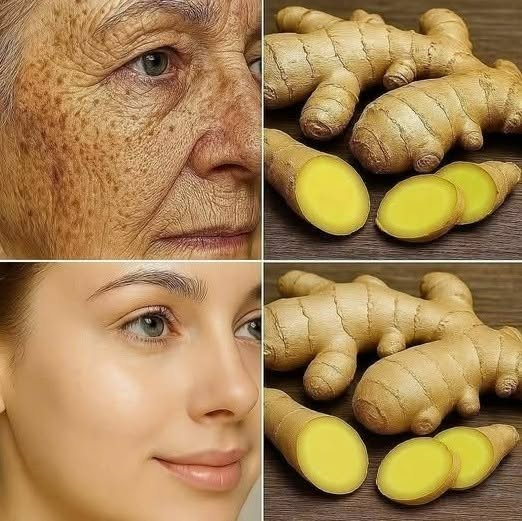 Ingwer ist 100-mal wirksamer als Botox bei der Beseitigung tiefer Falten, Sommersprossen und Pigmentflecken. Ich muss das einfach loswerden, damit ihr weiterhin meine Rezepte erhaltet… Danke! Rezept im Kommentar