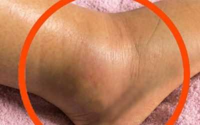 Wenn Sie bemerken, dass Ihre Beine geschwollen sind, ist dies ein Symptom einer Krankheit…