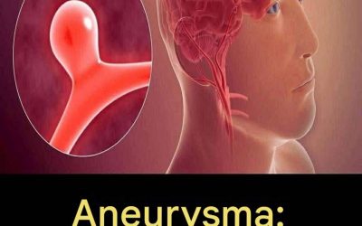 12 Anzeichen, die auf ein Hirnaneurysma hindeuten können – ignorieren Sie sie nicht!