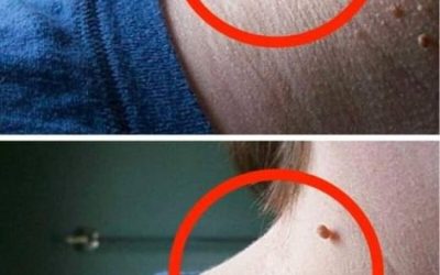 Wie kann man hängende Myome schnell und natürlich aus der Haut entfernen