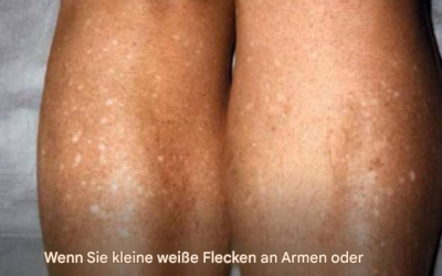 Warum bekomme ich im Sommer weiße Flecken auf der Haut und wie kann ich sie behandeln? Ein Dermatologe gibt die Antwort