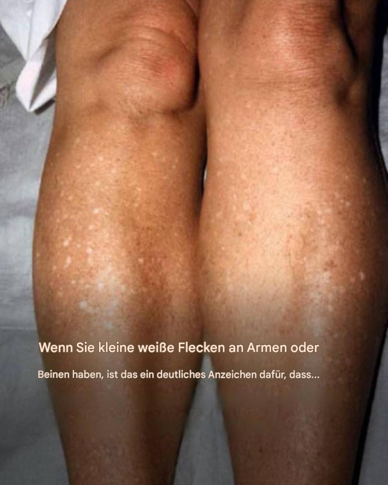 Warum bekomme ich im Sommer weiße Flecken auf der Haut und wie kann ich sie behandeln? Ein Dermatologe gibt die Antwort