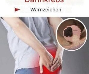 Dies sind die Symptome von Darmkrebs, die auftreten können… Mehr anzeigen