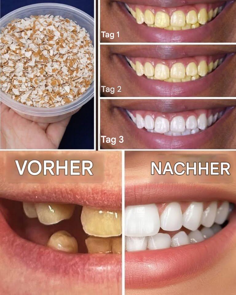 Eierschalen verwandeln gelbe Zähne in perlweiß in nur 5 Minuten*😱 Mehr dazu im ersten Kommentar⤵️